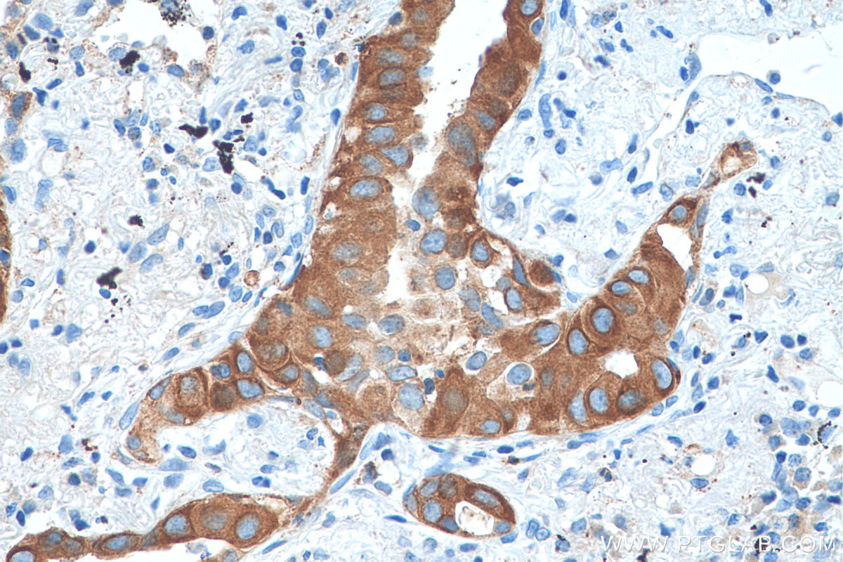 Immunohistochemistry (IHC) staining of human lung cancer tissue using GFRA2 Polyclonal antibody (55038-1-AP)