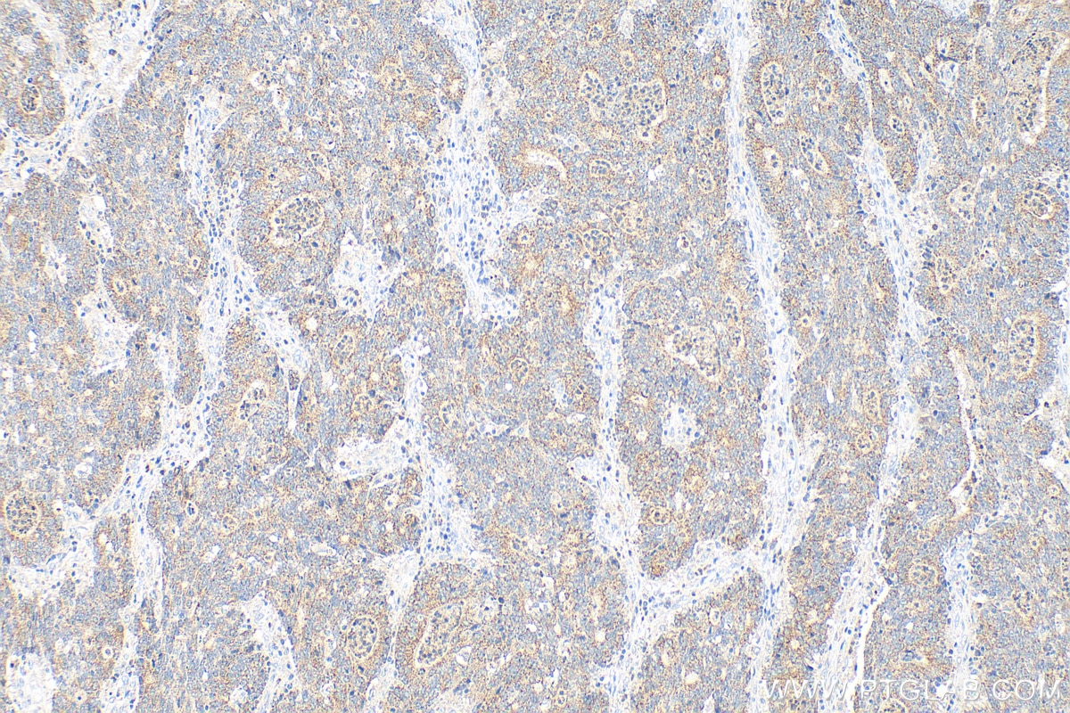 Immunohistochemistry (IHC) staining of human colon cancer tissue using GGA2 Polyclonal antibody (10356-1-AP)