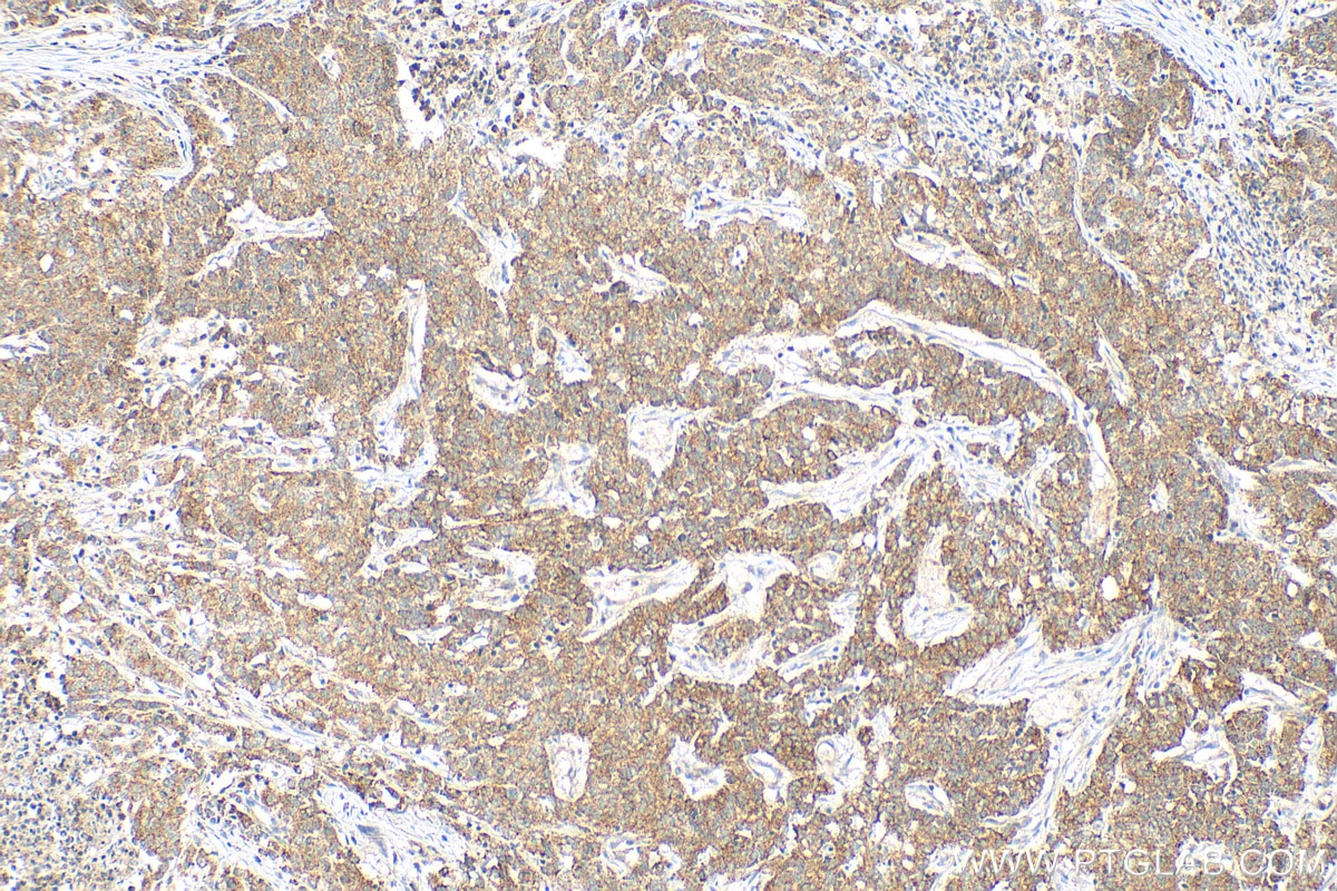 Immunohistochemistry (IHC) staining of human stomach cancer tissue using GGA2 Polyclonal antibody (10356-1-AP)