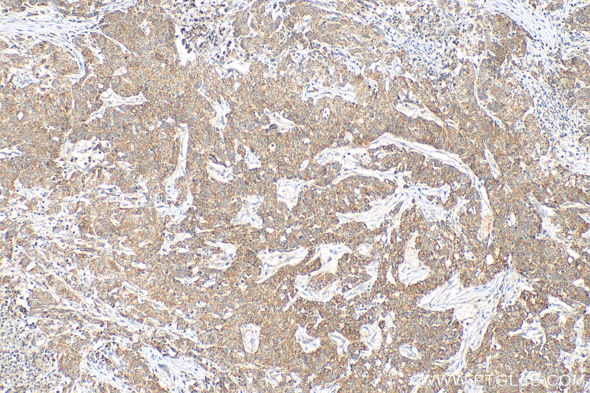 Immunohistochemistry (IHC) staining of human stomach cancer tissue using GGA2 Polyclonal antibody (10356-1-AP)