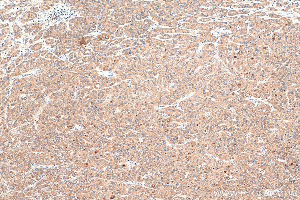 Immunohistochemistry (IHC) staining of human liver cancer tissue using GGPS1 Polyclonal antibody (29707-1-AP)