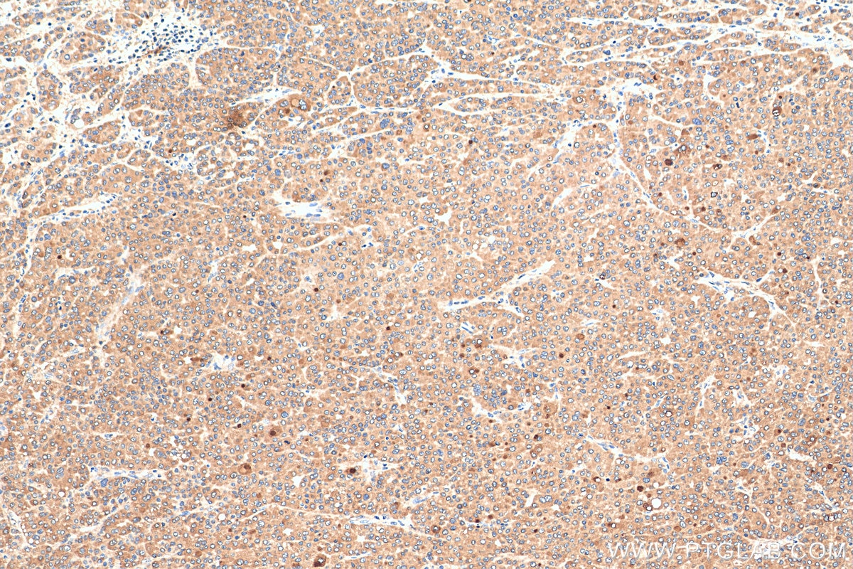 IHC staining of human liver cancer using 29707-1-AP