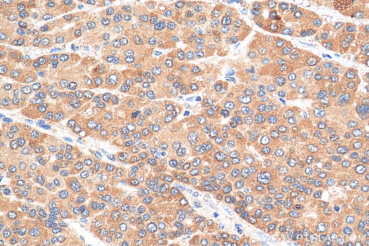 Immunohistochemistry (IHC) staining of human liver cancer tissue using GGPS1 Polyclonal antibody (29707-1-AP)