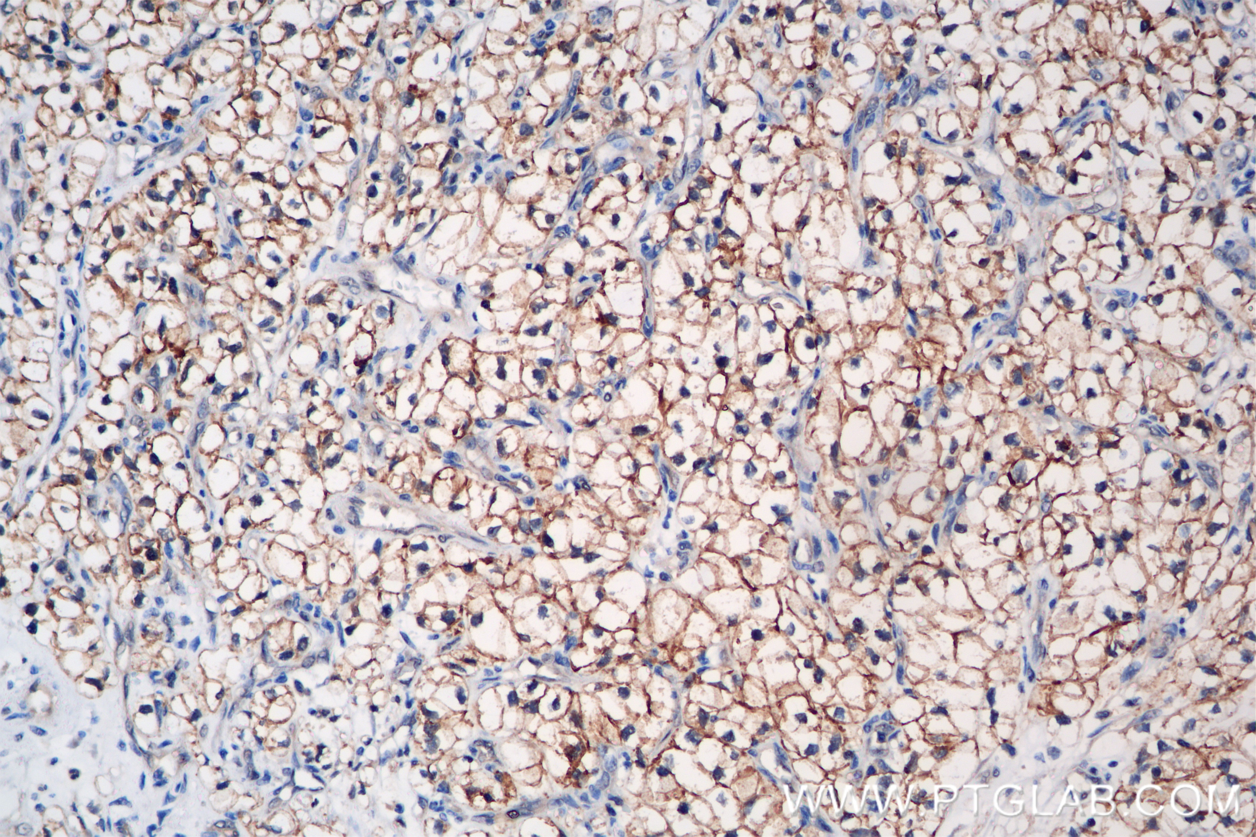 Immunohistochemical analysis of paraffin-embedded Human Kidney(renal cell) Cancer slide using 83304-1-PBS (GGT1 antibody) at dilution of 1:800 (under 20x lens). Heat mediated antigen retrieval with Tris-EDTA buffer (pH 9.0). Immunohistochemistry (IHC) staining of Human Kidney(renal cell) Cancer using GGT1 Recombinant antibody, PBS Only (83304-1-PBS)