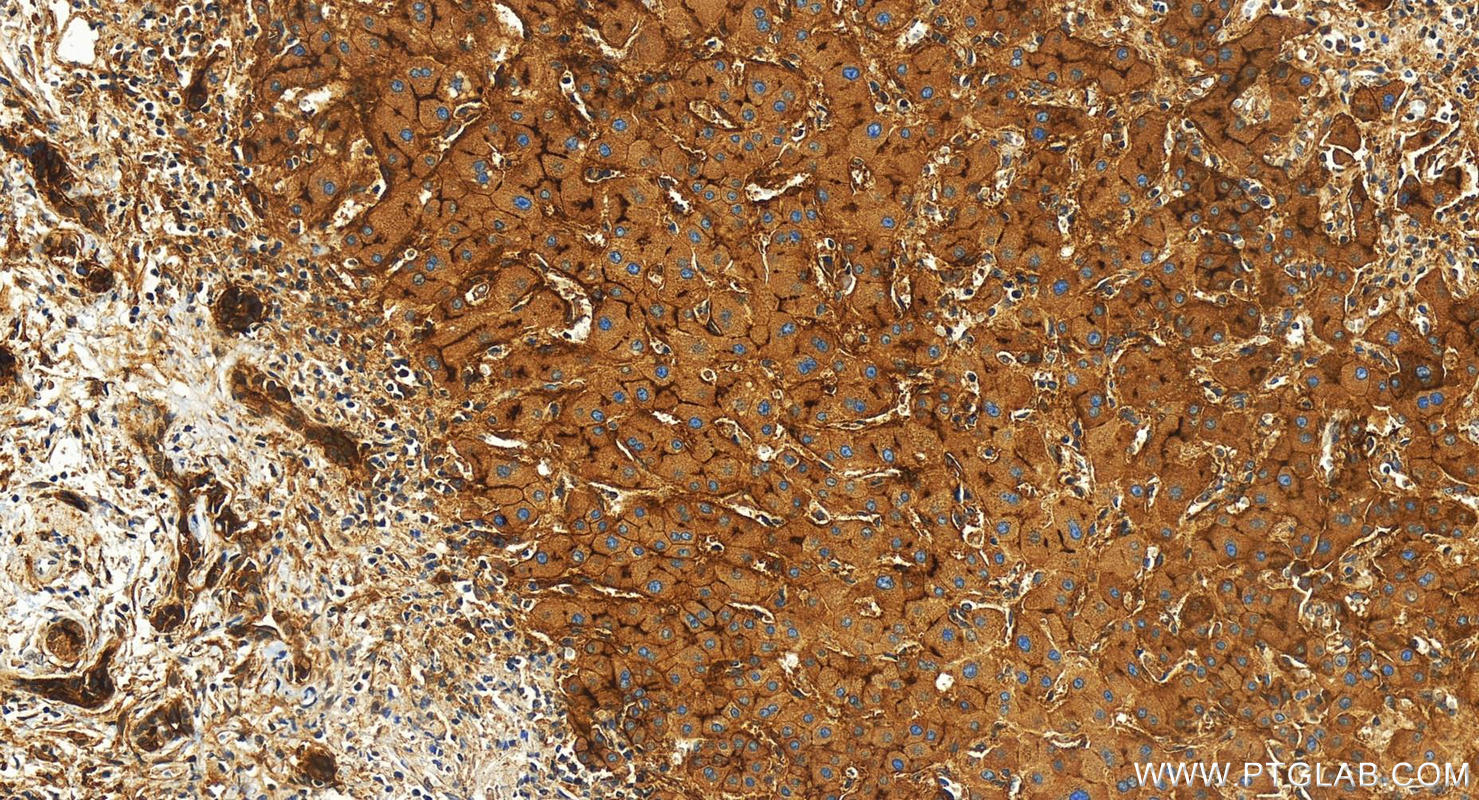 Immunohistochemistry (IHC) staining of human intrahepatic cholangiocarcinoma tissue using GGT1 Recombinant antibody (83304-1-RR)