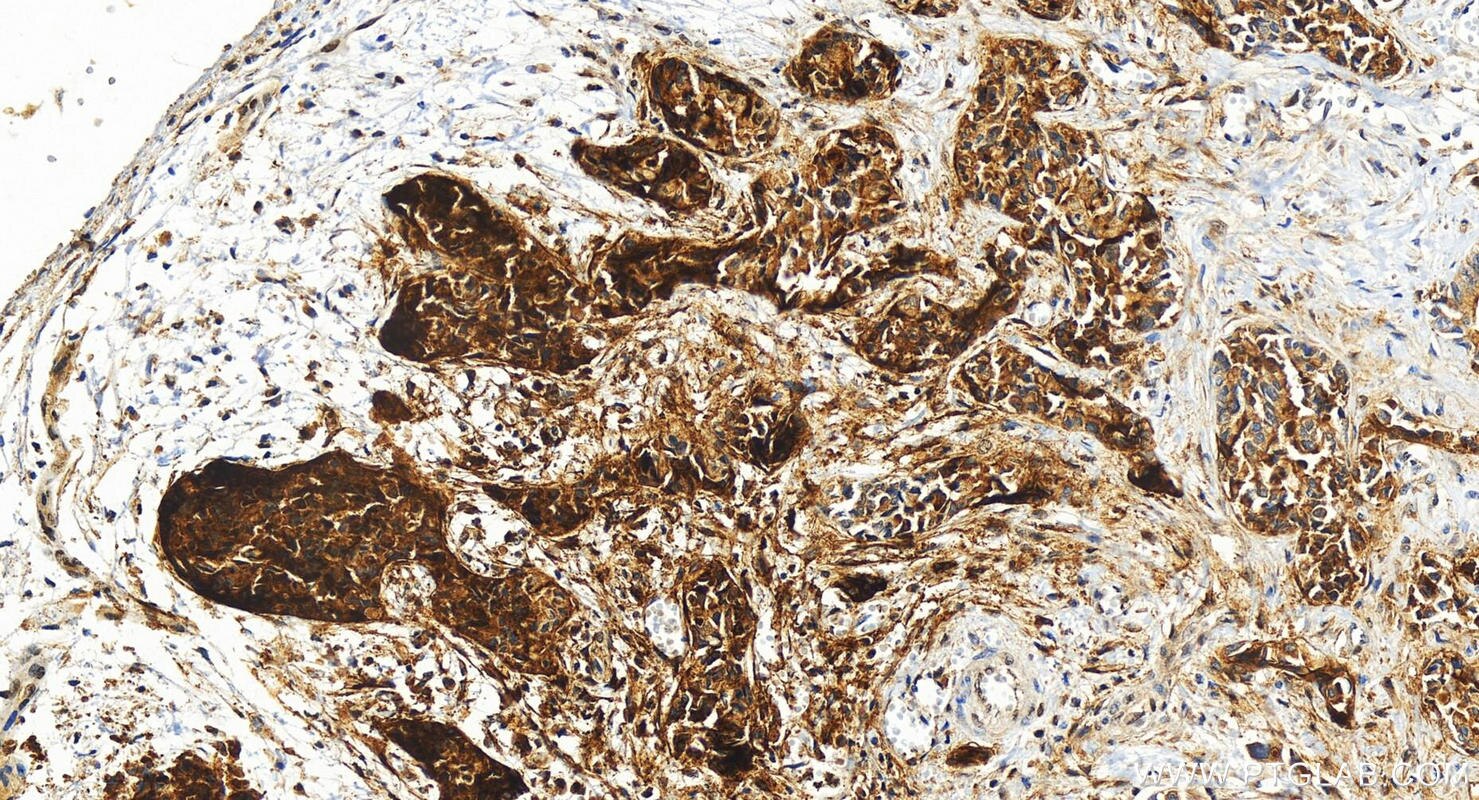 Immunohistochemistry (IHC) staining of human intrahepatic cholangiocarcinoma tissue using GGT1 Recombinant antibody (83304-1-RR)