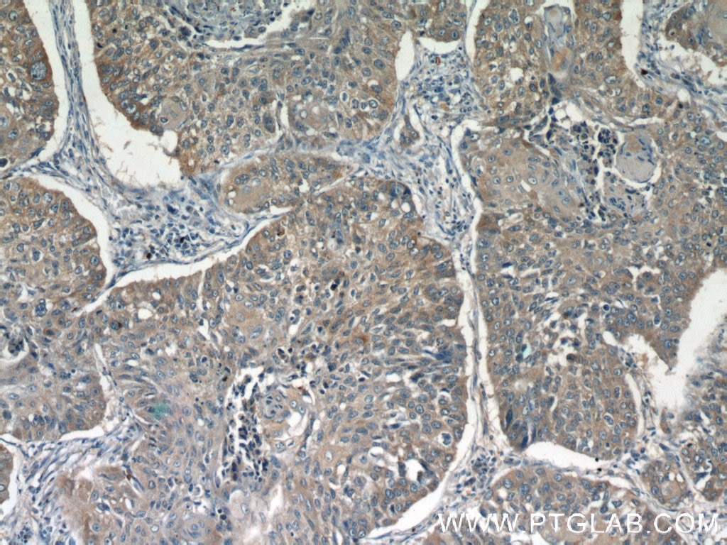 Immunohistochemistry (IHC) staining of human lung cancer tissue using GGT7 Polyclonal antibody (24674-1-AP)