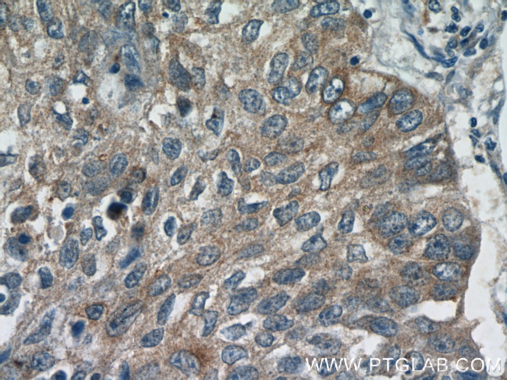 Immunohistochemistry (IHC) staining of human lung cancer tissue using GGT7 Polyclonal antibody (24674-1-AP)