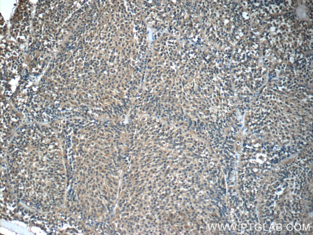 Immunohistochemistry (IHC) staining of human pituitary adenoma tissue using GH1 Polyclonal antibody (55243-1-AP)