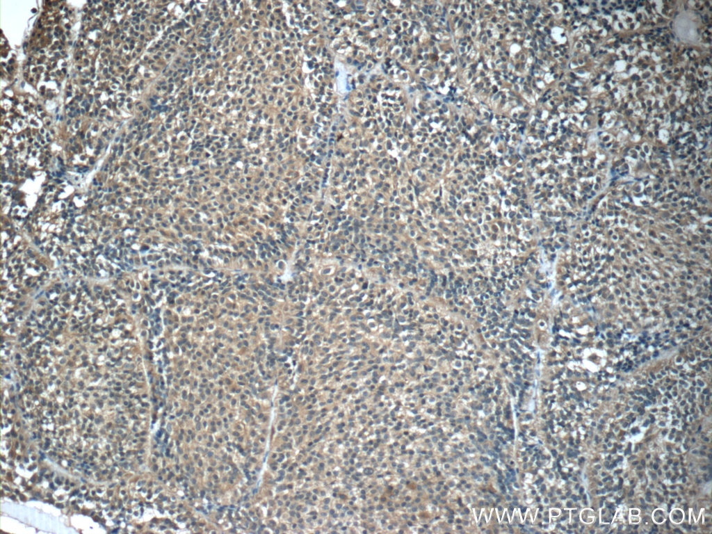 IHC staining of human pituitary adenoma using 55243-1-AP