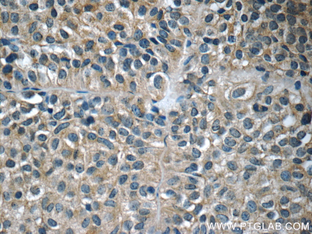 Immunohistochemistry (IHC) staining of human pituitary adenoma tissue using GH1 Polyclonal antibody (55243-1-AP)