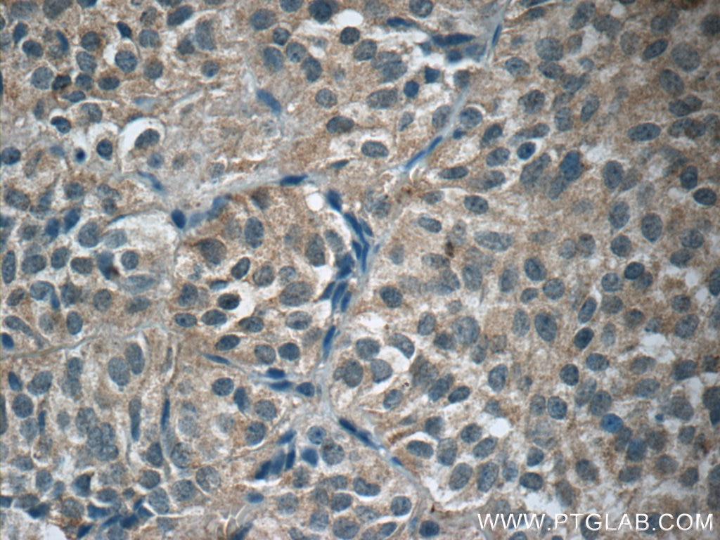 Immunohistochemistry (IHC) staining of human pituitary adenoma tissue using GH2 Polyclonal antibody (55240-1-AP)