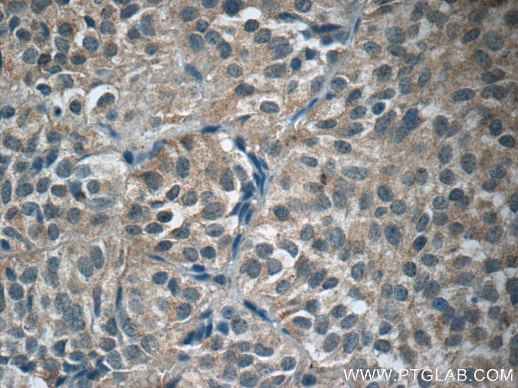 IHC staining of human pituitary adenoma using 55240-1-AP