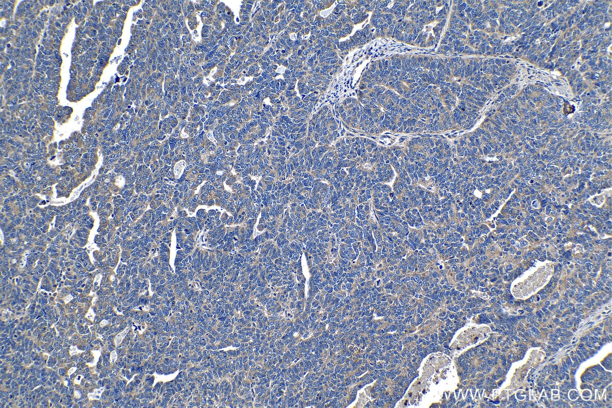Immunohistochemistry (IHC) staining of human ovary tumor tissue using GHDC Polyclonal antibody (26123-1-AP)