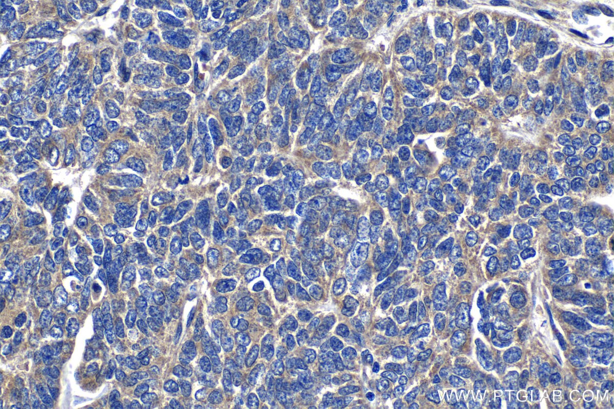 Immunohistochemistry (IHC) staining of human ovary tumor tissue using GHDC Polyclonal antibody (26123-1-AP)