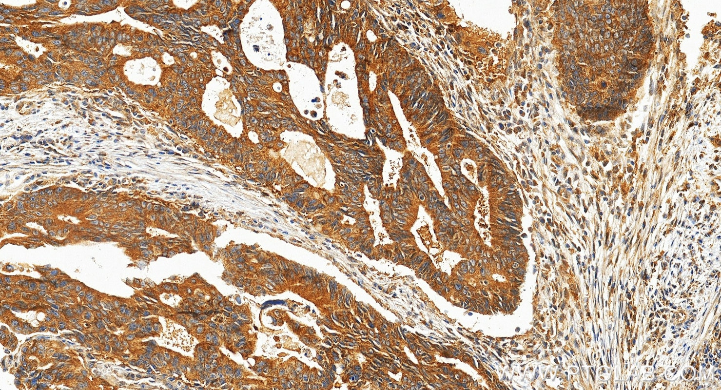 IHC staining of human colon cancer using 19896-1-AP (same clone as 19896-1-PBS) Immunohistochemistry (IHC) staining of human colon cancer tissue using GHRH Polyclonal antibody (19896-1-AP)