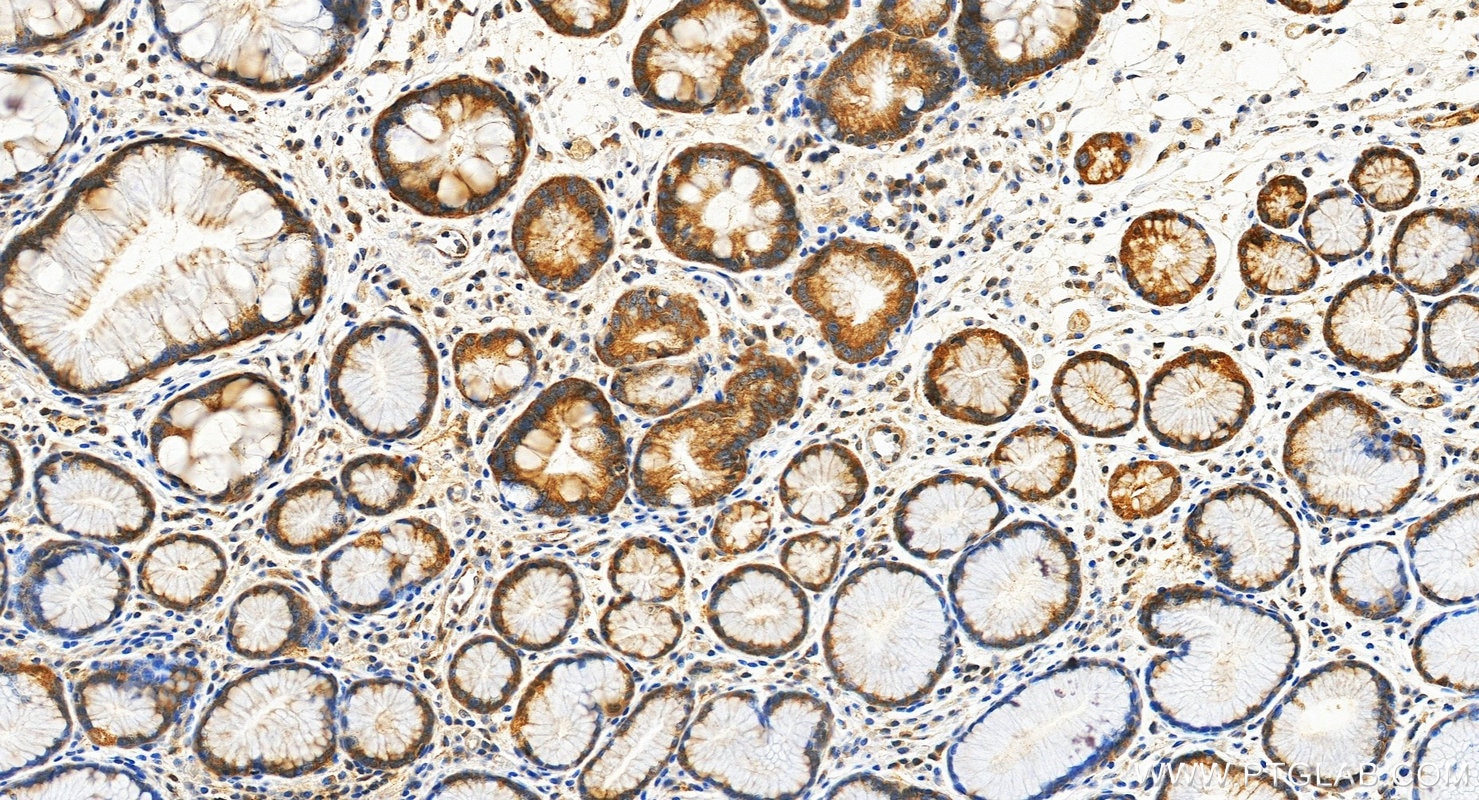 IHC staining of human stomach cancer using 19896-1-AP (same clone as 19896-1-PBS) Immunohistochemistry (IHC) staining of human stomach cancer tissue using GHRH Polyclonal antibody (19896-1-AP)