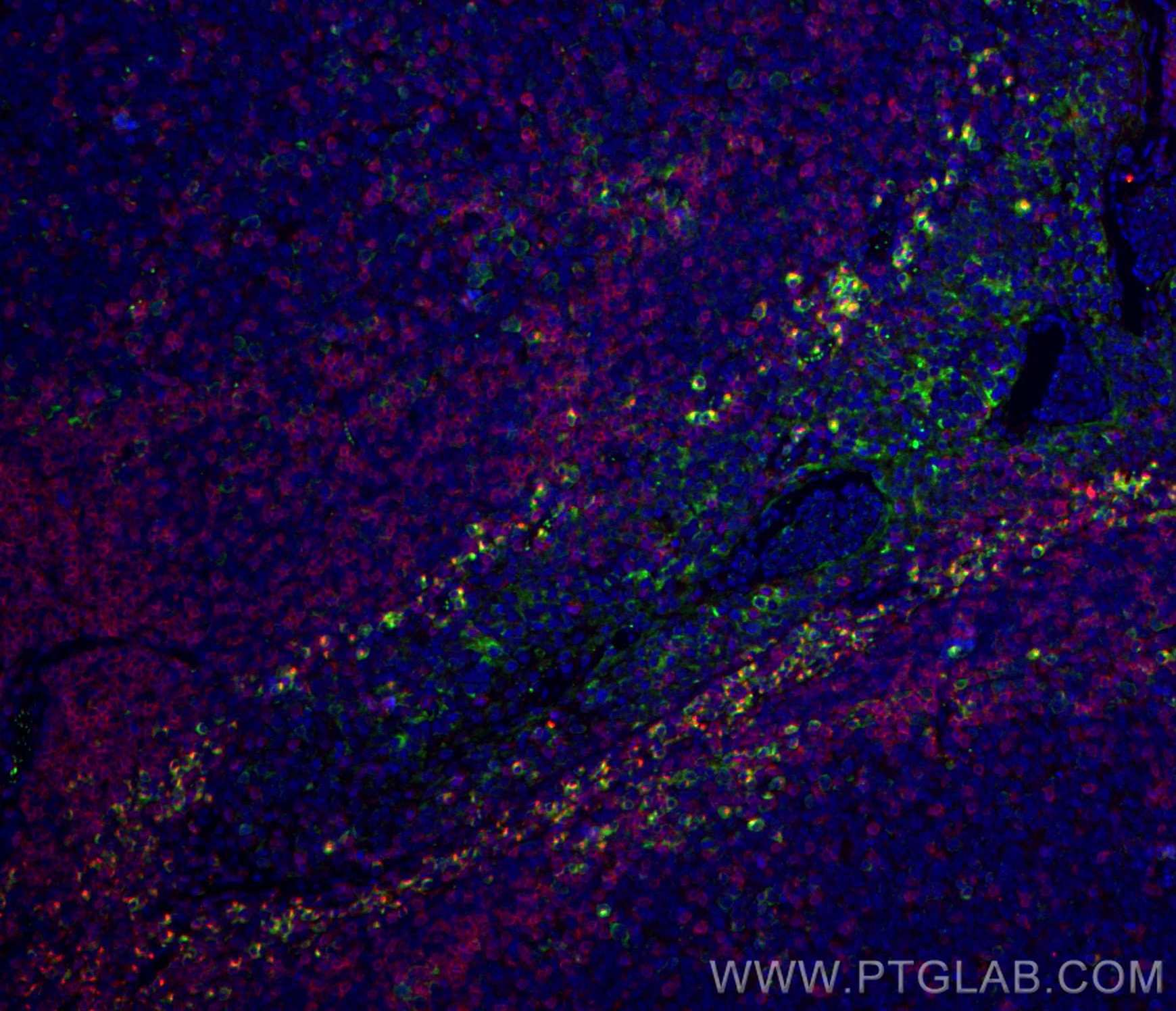 Immunofluorescence (IF) / fluorescent staining of human tonsillitis tissue using VISTA Polyclonal antibody (24849-1-AP)