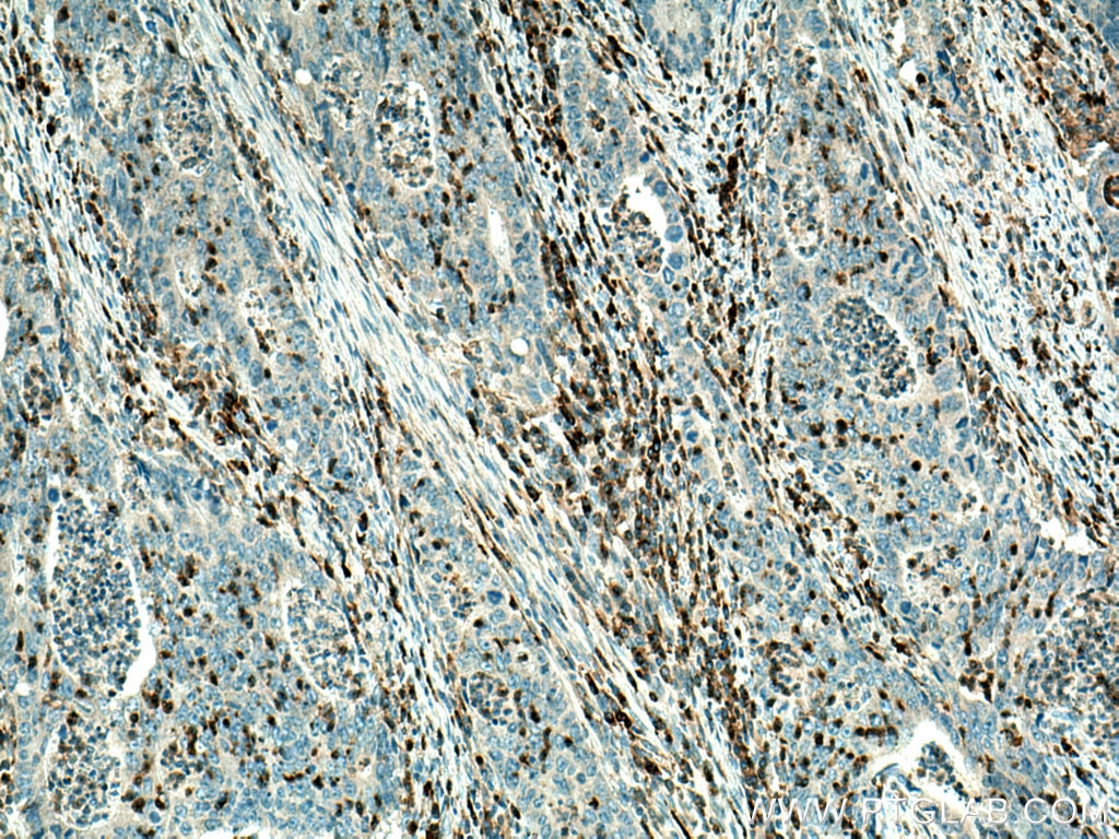 Immunohistochemistry (IHC) staining of human colon cancer tissue using VISTA Polyclonal antibody (24849-1-AP)
