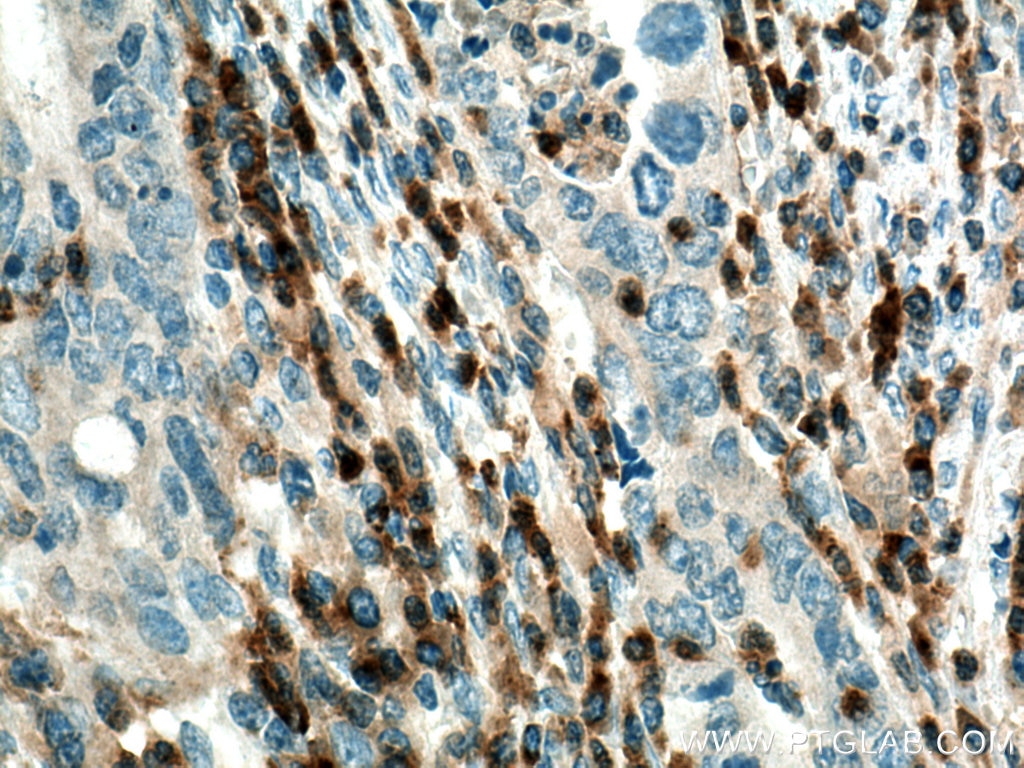 Immunohistochemistry (IHC) staining of human colon cancer tissue using VISTA Polyclonal antibody (24849-1-AP)