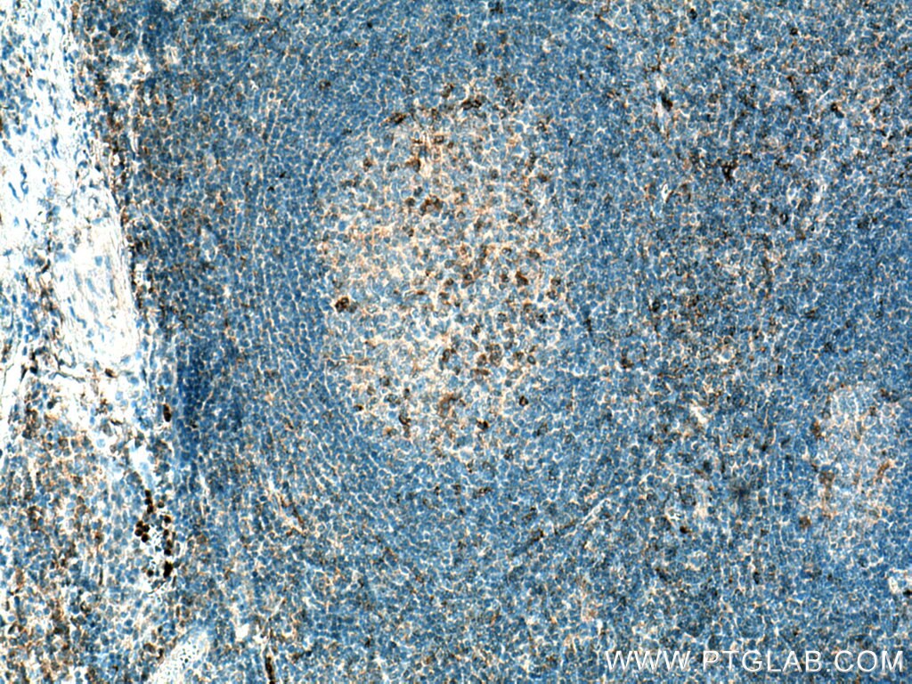 Immunohistochemistry (IHC) staining of human tonsillitis tissue using VISTA Polyclonal antibody (24849-1-AP)