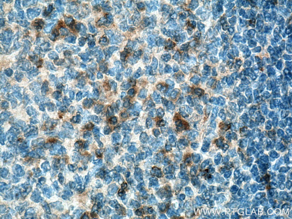 Immunohistochemistry (IHC) staining of human tonsillitis tissue using VISTA Polyclonal antibody (24849-1-AP)