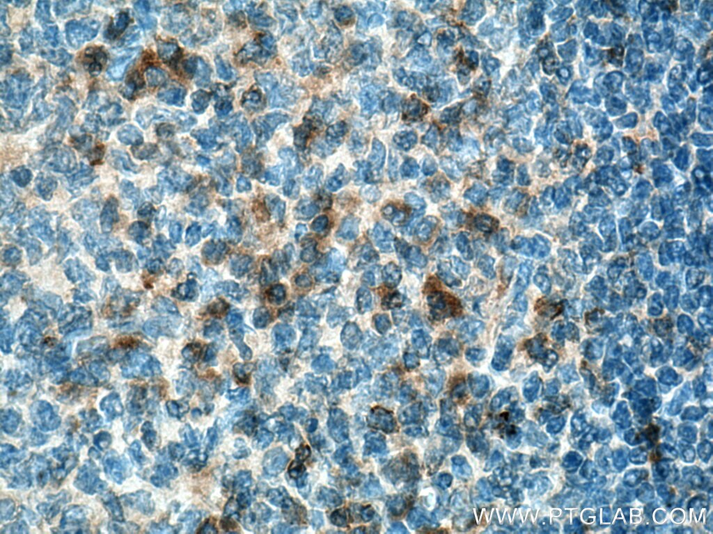 IHC staining of human tonsillitis using 24849-1-AP