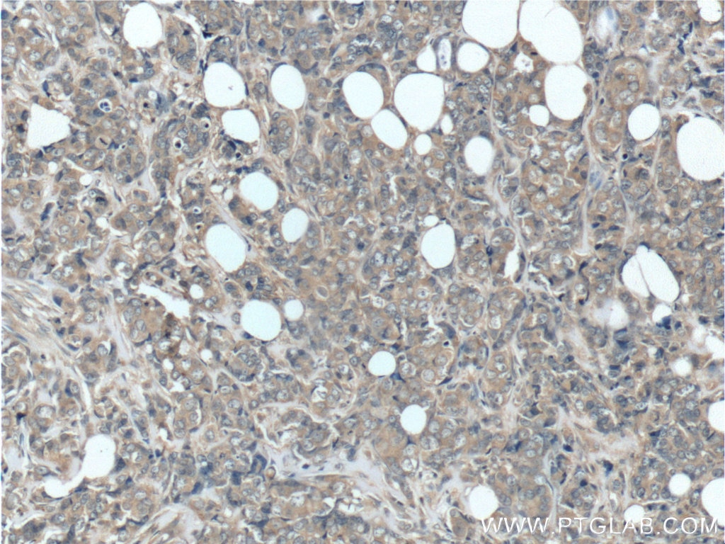 Immunohistochemistry (IHC) staining of human breast cancer tissue using GIGYF2 Polyclonal antibody (24790-1-AP)