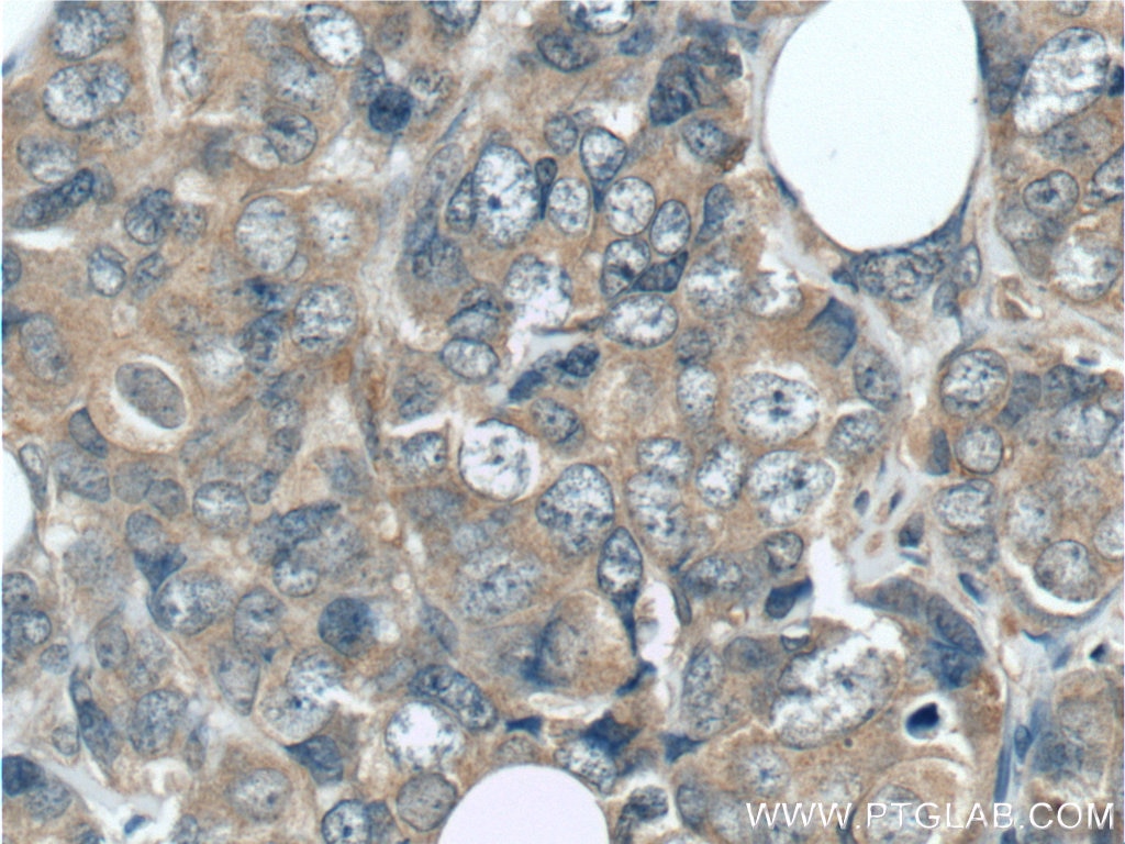 Immunohistochemistry (IHC) staining of human breast cancer tissue using GIGYF2 Polyclonal antibody (24790-1-AP)