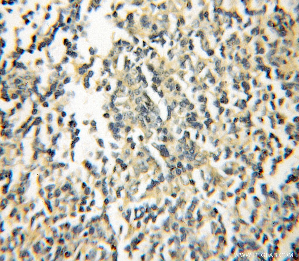 Immunohistochemistry (IHC) staining of human lymphoma tissue using GIMAP5 Polyclonal antibody (11068-1-AP)
