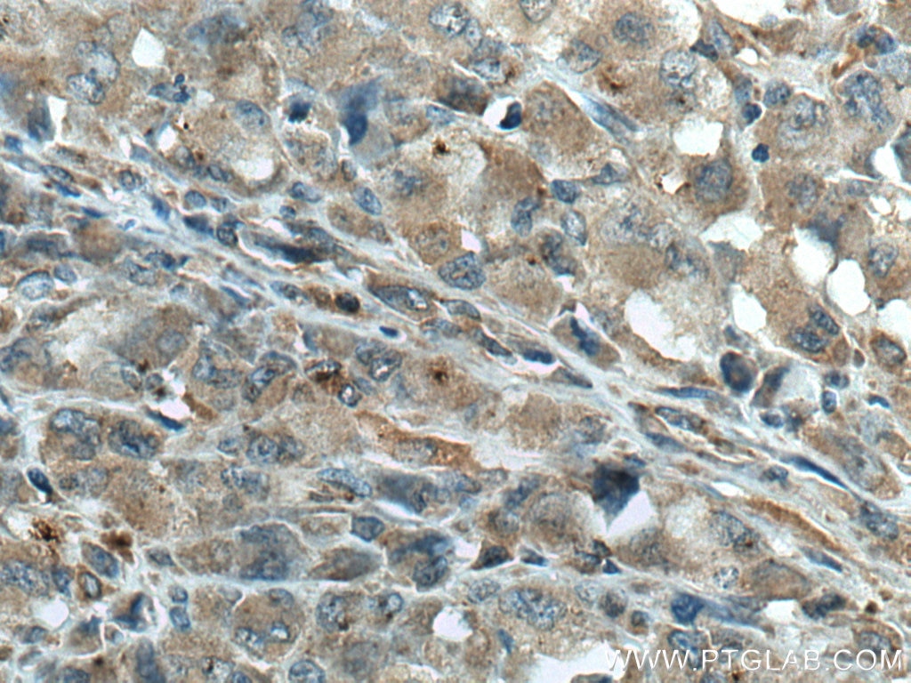 Immunohistochemistry (IHC) staining of human lymphoma tissue using GIMAP5 Monoclonal antibody (66943-1-Ig)