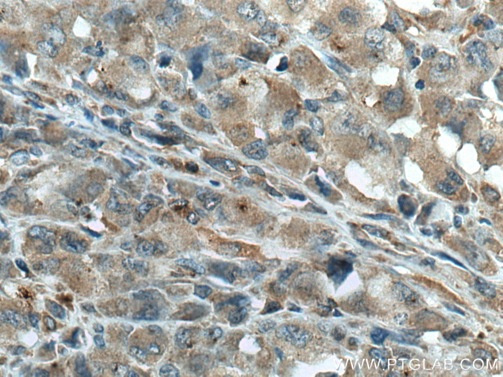 IHC staining of human lymphoma using 66943-1-Ig