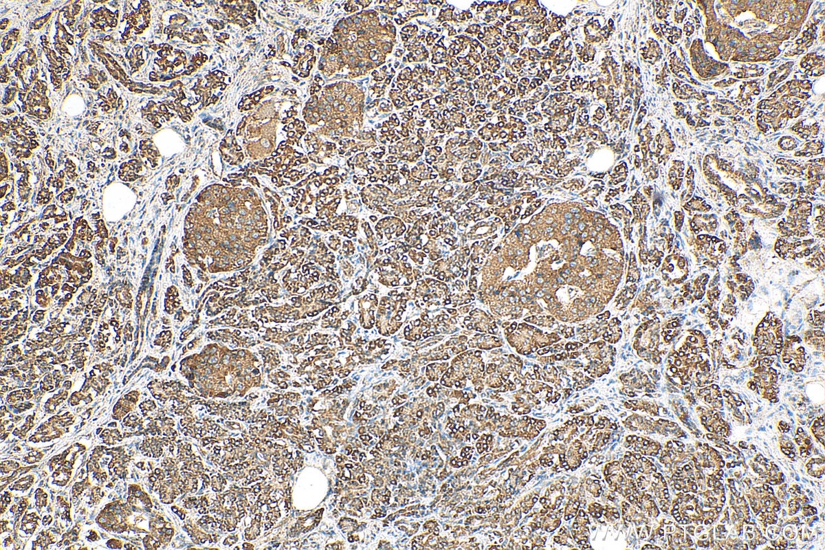 Immunohistochemistry (IHC) staining of human pancreas cancer tissue using PSF2 Polyclonal antibody (16247-1-AP)