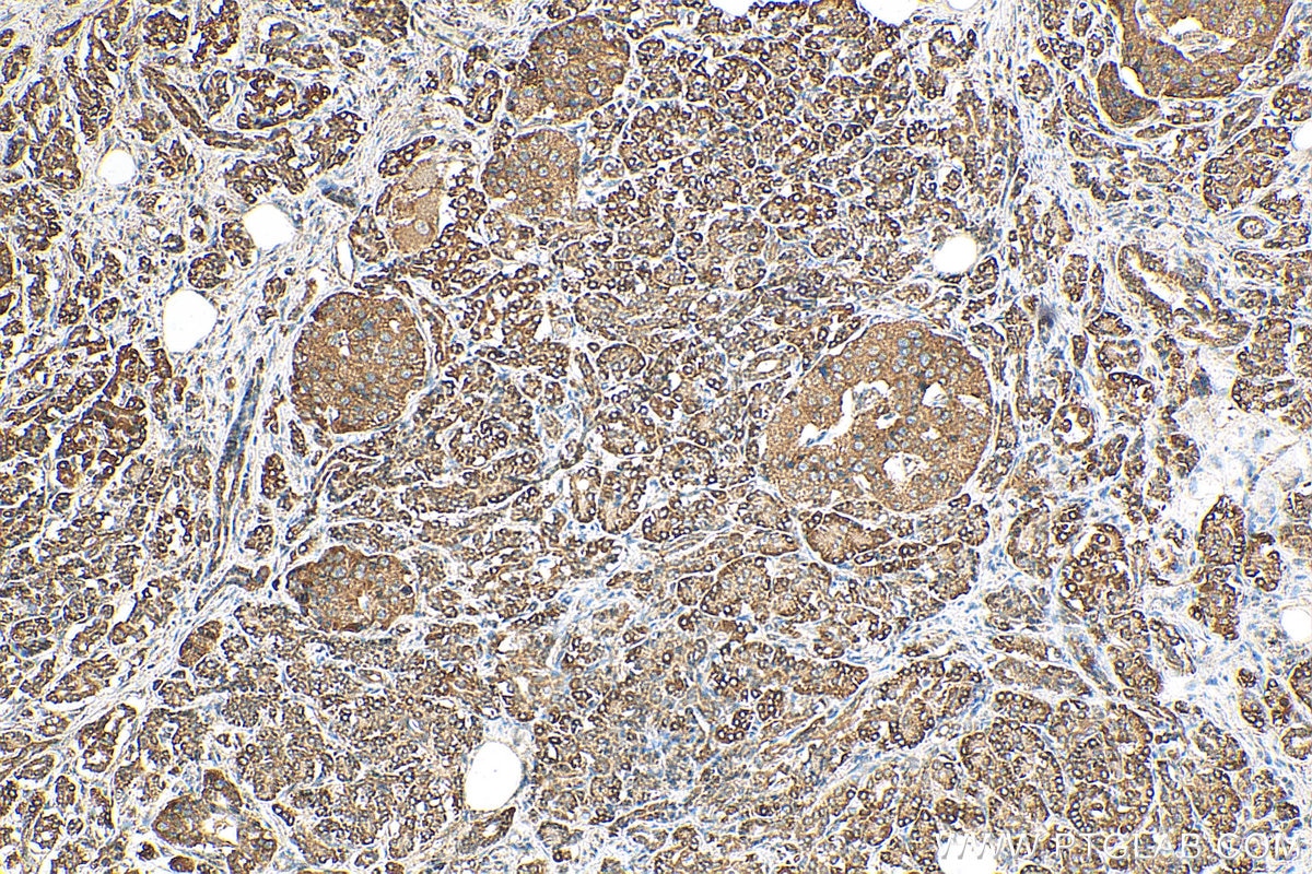 Immunohistochemistry (IHC) staining of human pancreas cancer tissue using GINS2 Polyclonal antibody (16247-1-AP)
