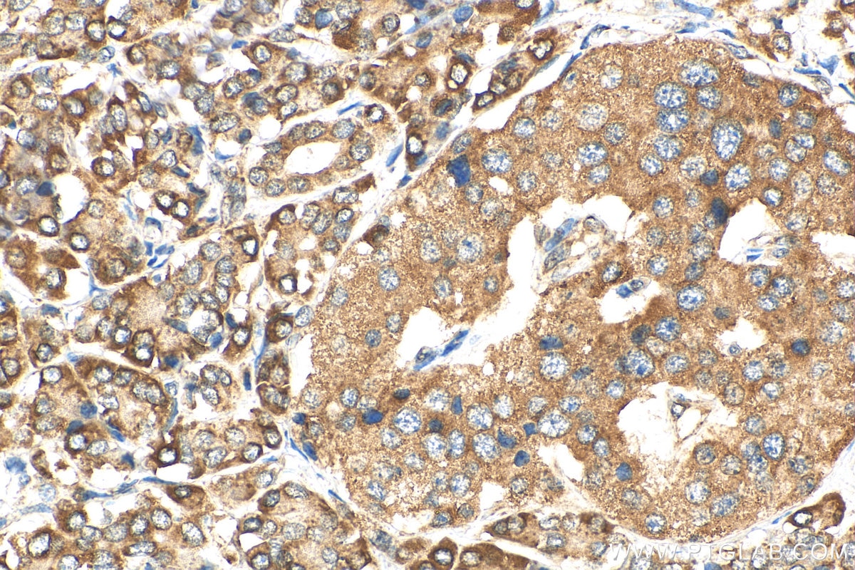 Immunohistochemistry (IHC) staining of human pancreas cancer tissue using GINS2 Polyclonal antibody (16247-1-AP)