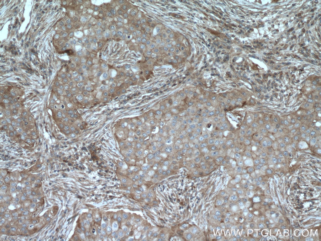 Immunohistochemistry (IHC) staining of human breast cancer tissue using GIPC1 Polyclonal antibody (14822-1-AP)