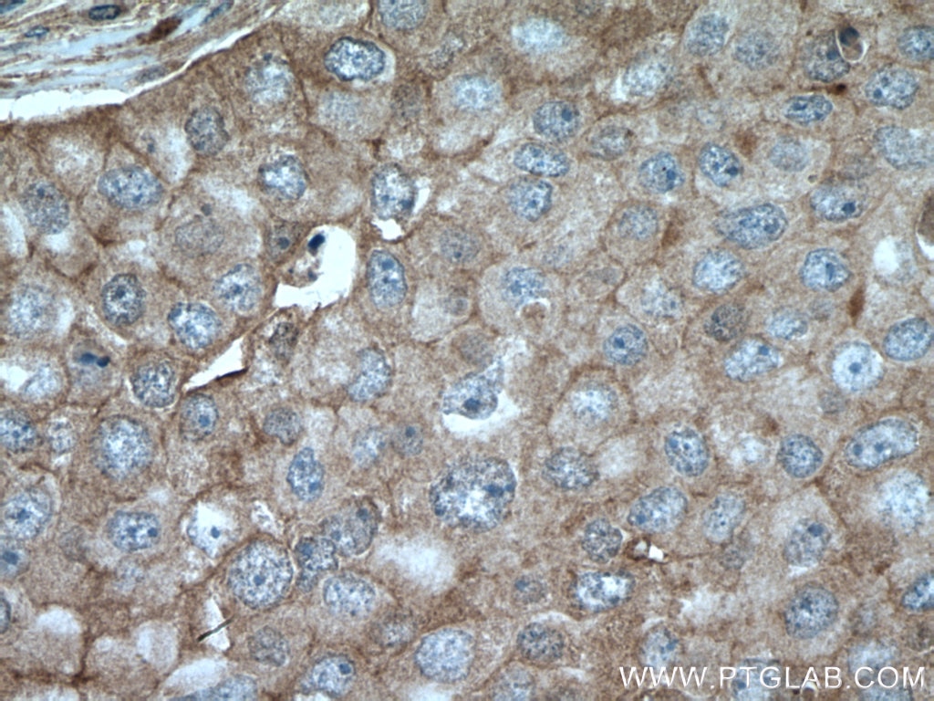 Immunohistochemistry (IHC) staining of human breast cancer tissue using GIPC1 Polyclonal antibody (14822-1-AP)