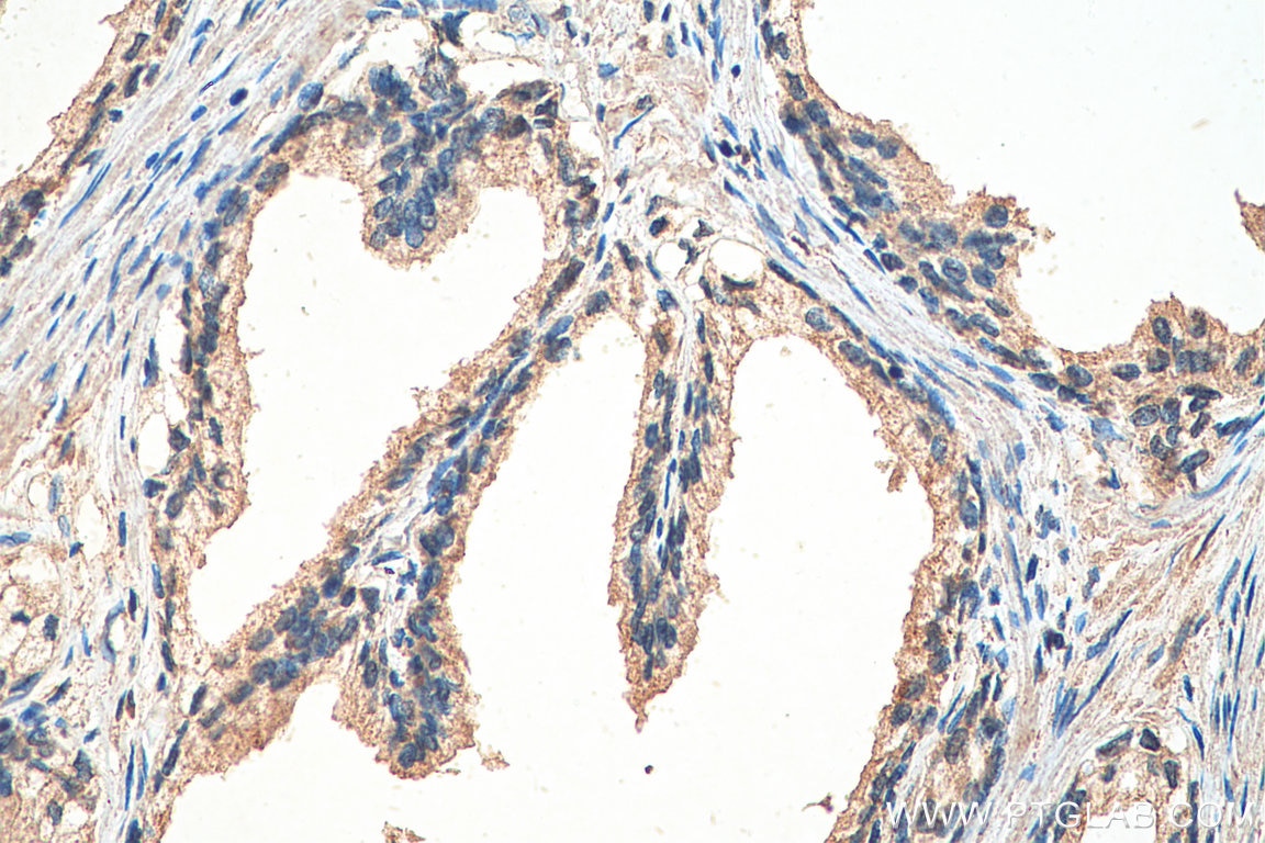 Immunohistochemistry (IHC) staining of human prostate cancer tissue using GIT2 Monoclonal antibody (67858-1-Ig)