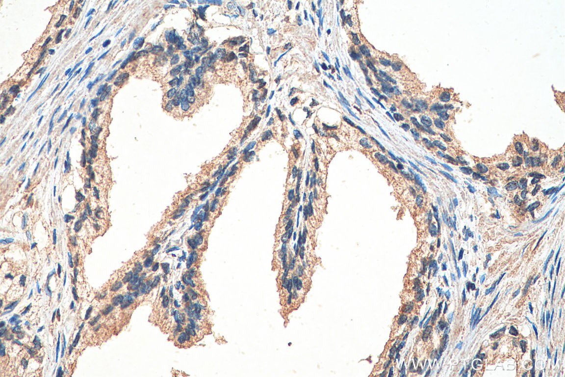 IHC staining of human prostate cancer using 67858-1-Ig