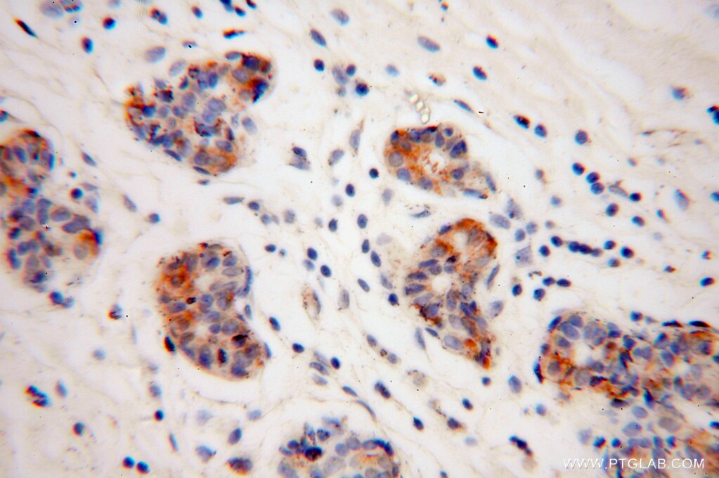 Immunohistochemistry (IHC) staining of human colon cancer tissue using Connexin-32 Polyclonal antibody (10450-1-AP)