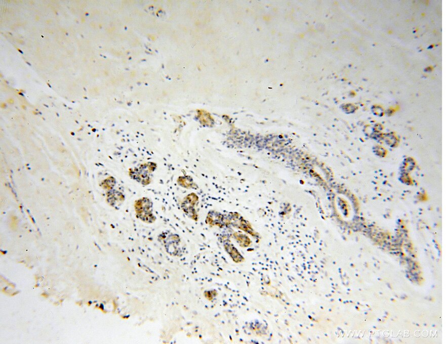 Immunohistochemistry (IHC) staining of human colon cancer tissue using Connexin-32 Polyclonal antibody (10450-1-AP)