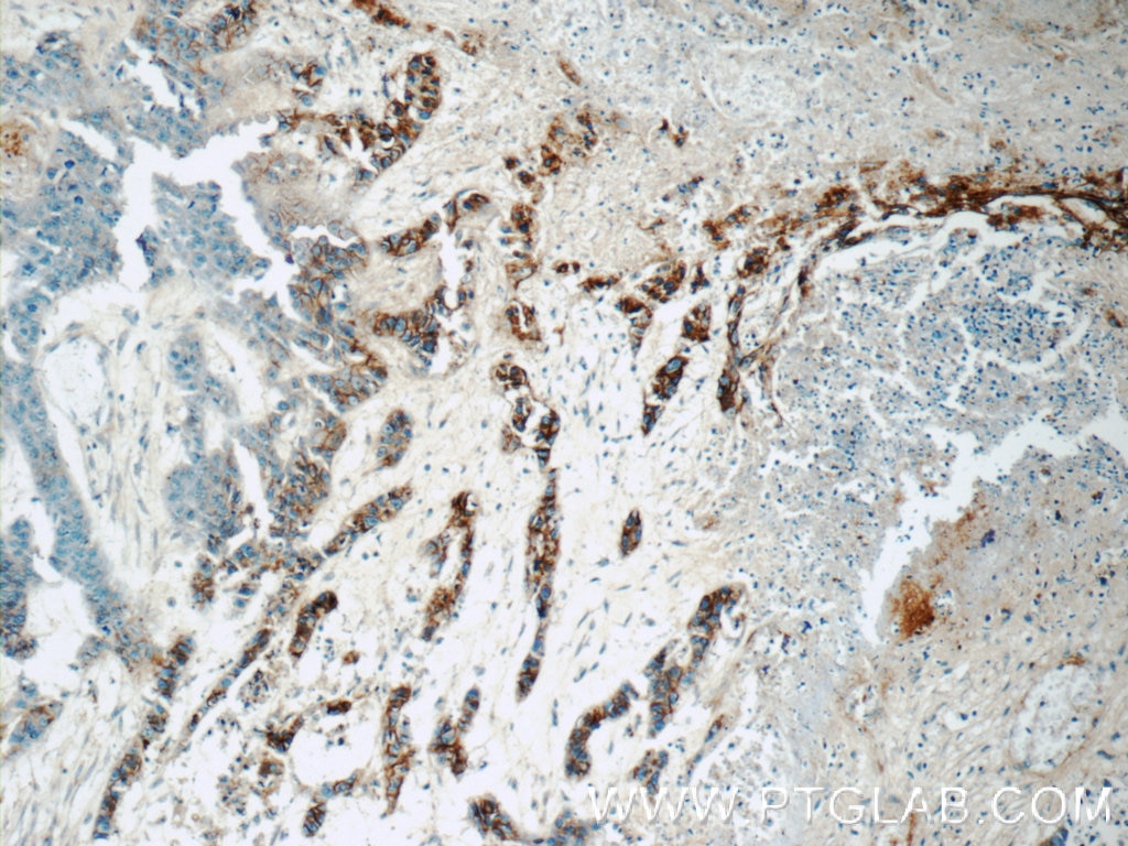 Immunohistochemistry (IHC) staining of human skin cancer tissue using GJB3 Polyclonal antibody (12880-1-AP)