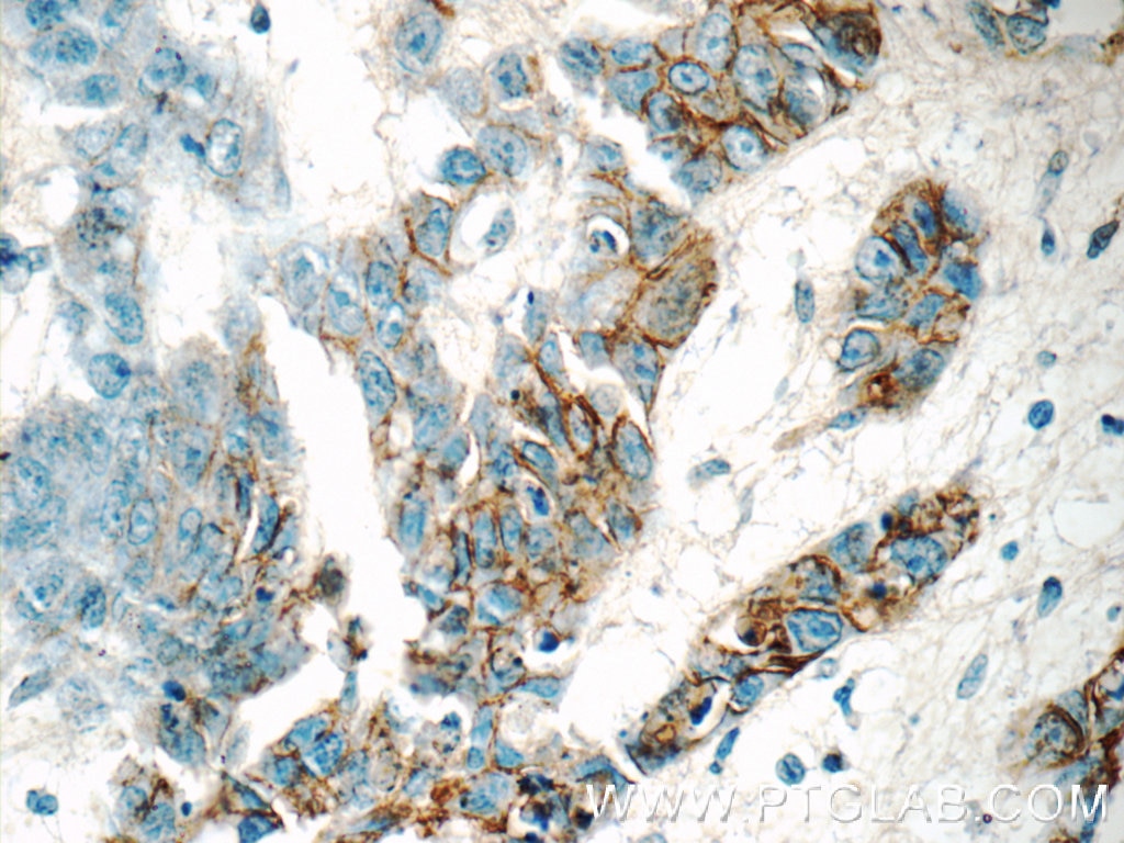 Immunohistochemistry (IHC) staining of human skin cancer tissue using GJB3 Polyclonal antibody (12880-1-AP)