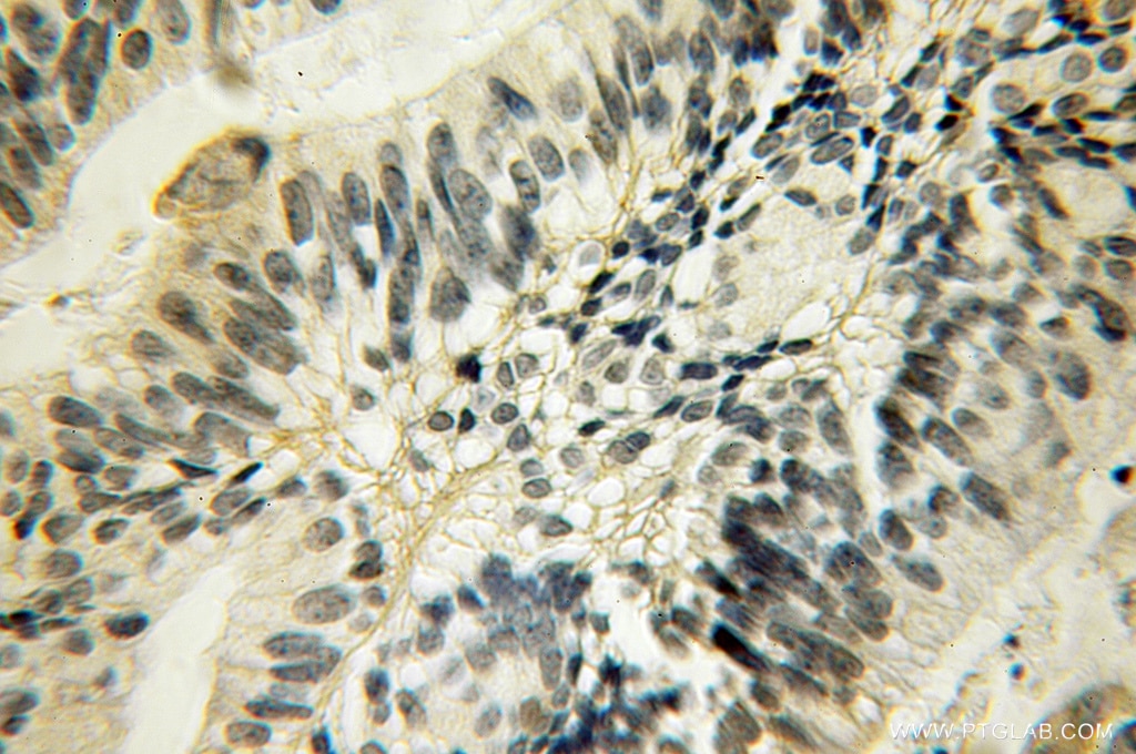 Immunohistochemistry (IHC) staining of human ovary tumor tissue using GJB3 Polyclonal antibody (12880-1-AP)