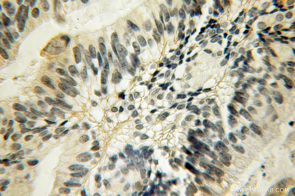 IHC staining of human ovary tumor using 12880-1-AP