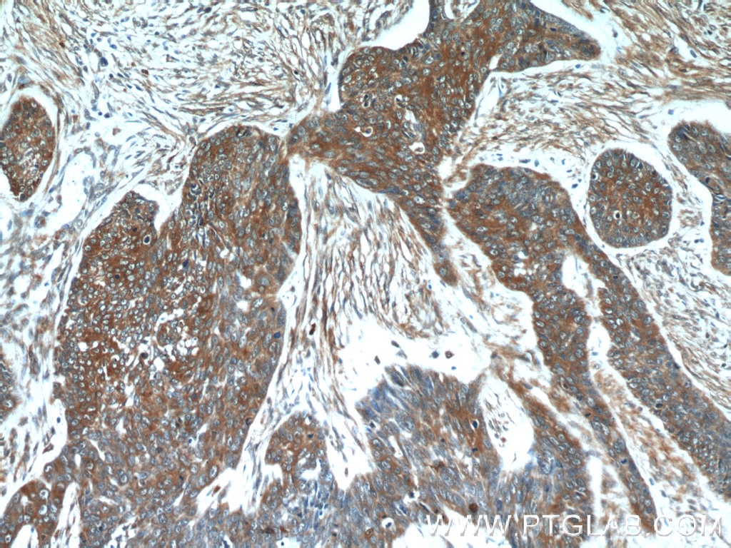 Immunohistochemistry (IHC) staining of human skin cancer tissue using GJB6 Polyclonal antibody (24215-1-AP)