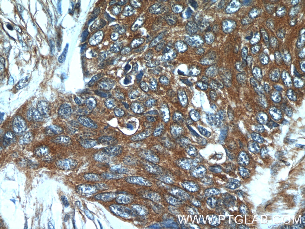 Immunohistochemistry (IHC) staining of human skin cancer tissue using GJB6 Polyclonal antibody (24215-1-AP)