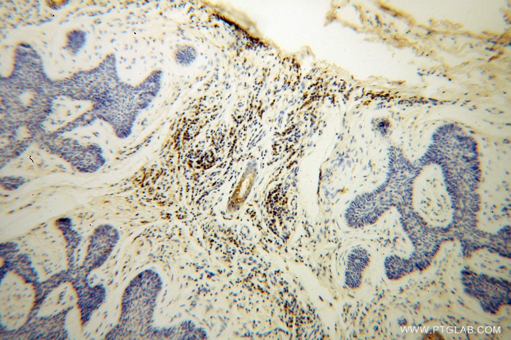 Immunohistochemistry (IHC) staining of human skin cancer tissue using GK3P Polyclonal antibody (14176-1-AP)