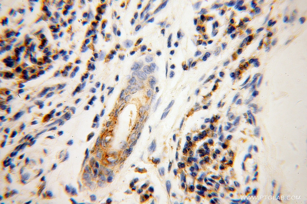 Immunohistochemistry (IHC) staining of human skin cancer tissue using GK3P Polyclonal antibody (14176-1-AP)