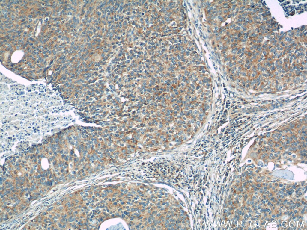 Immunohistochemistry (IHC) staining of human cervical cancer tissue using GKAP1 Polyclonal antibody (11395-1-AP)